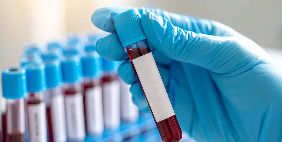 CRP Test Price: Cost, Procedure and Test Details