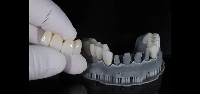 How Can Dental Bridges Replace Missing Teeth?