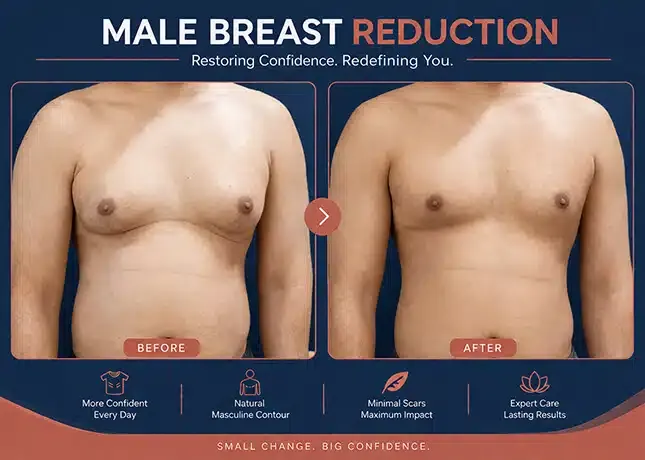 Gynecomastia Surgery in Delhi - Dr Rajat Gupta