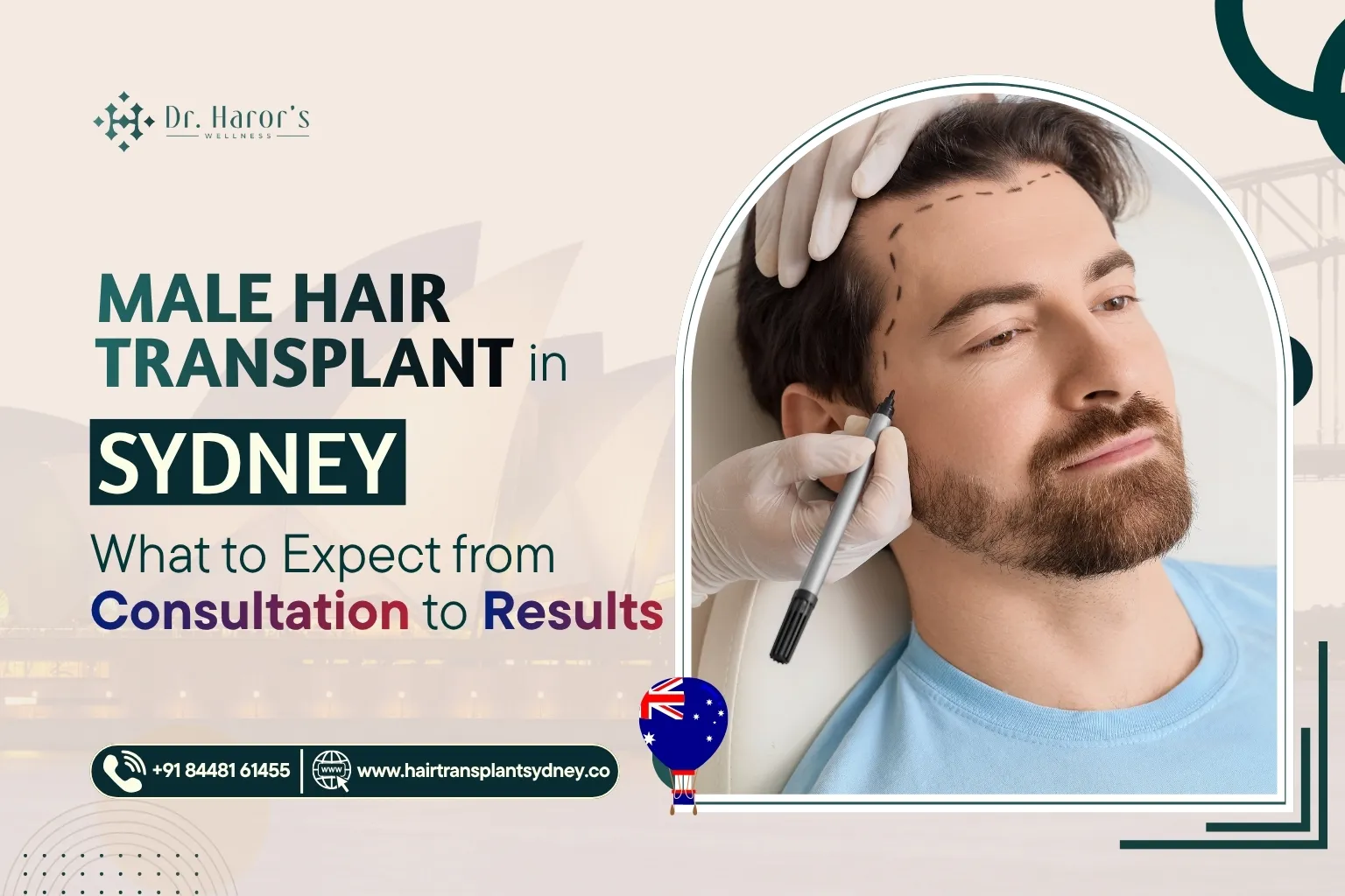 Male Hair Transplant in Sydney: What to Expect from Consultation to Results