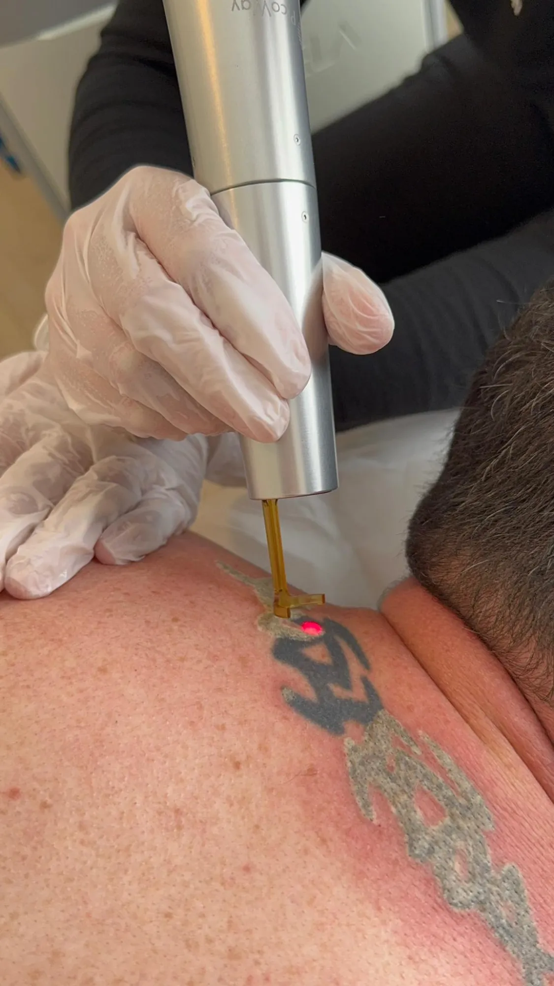 Laser Tattoo Removal in Mississauga: What to Expect