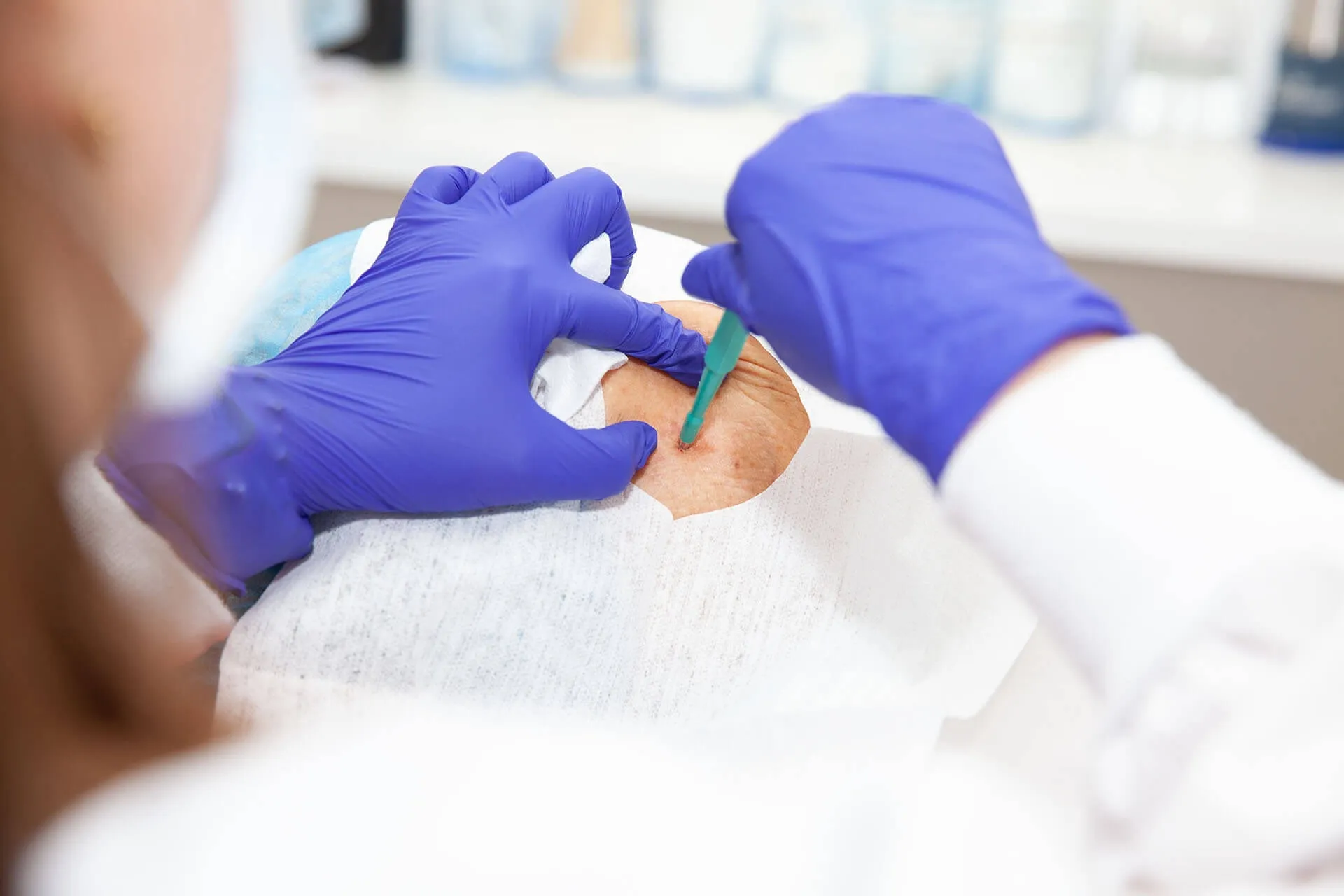 Cryotherapy Near Me: Visit Reputable Skin Cancer Check Clinics for Early Detection!