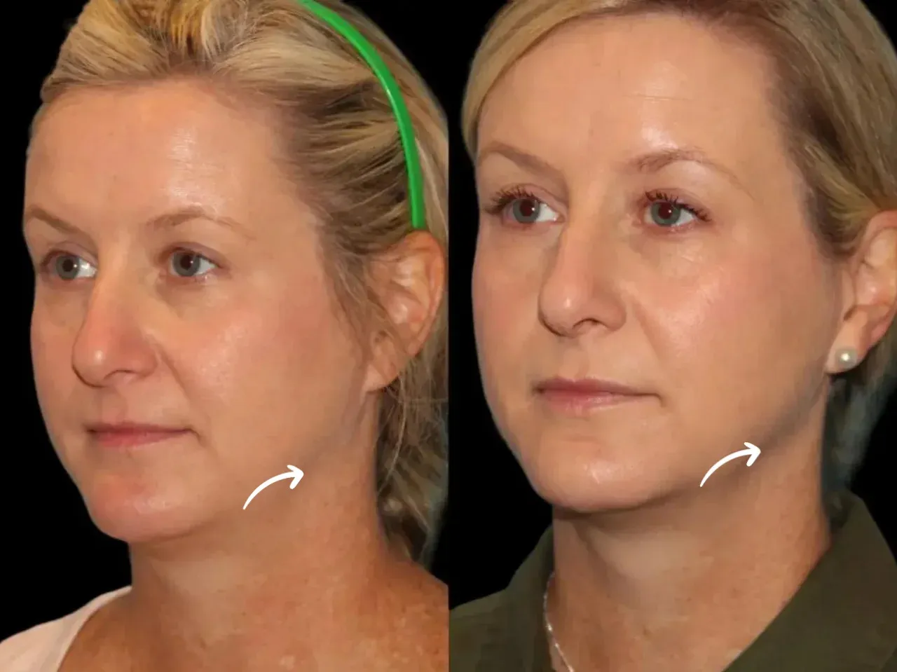 Sculptra Treatment in Dubai for Dry Elbow Texture