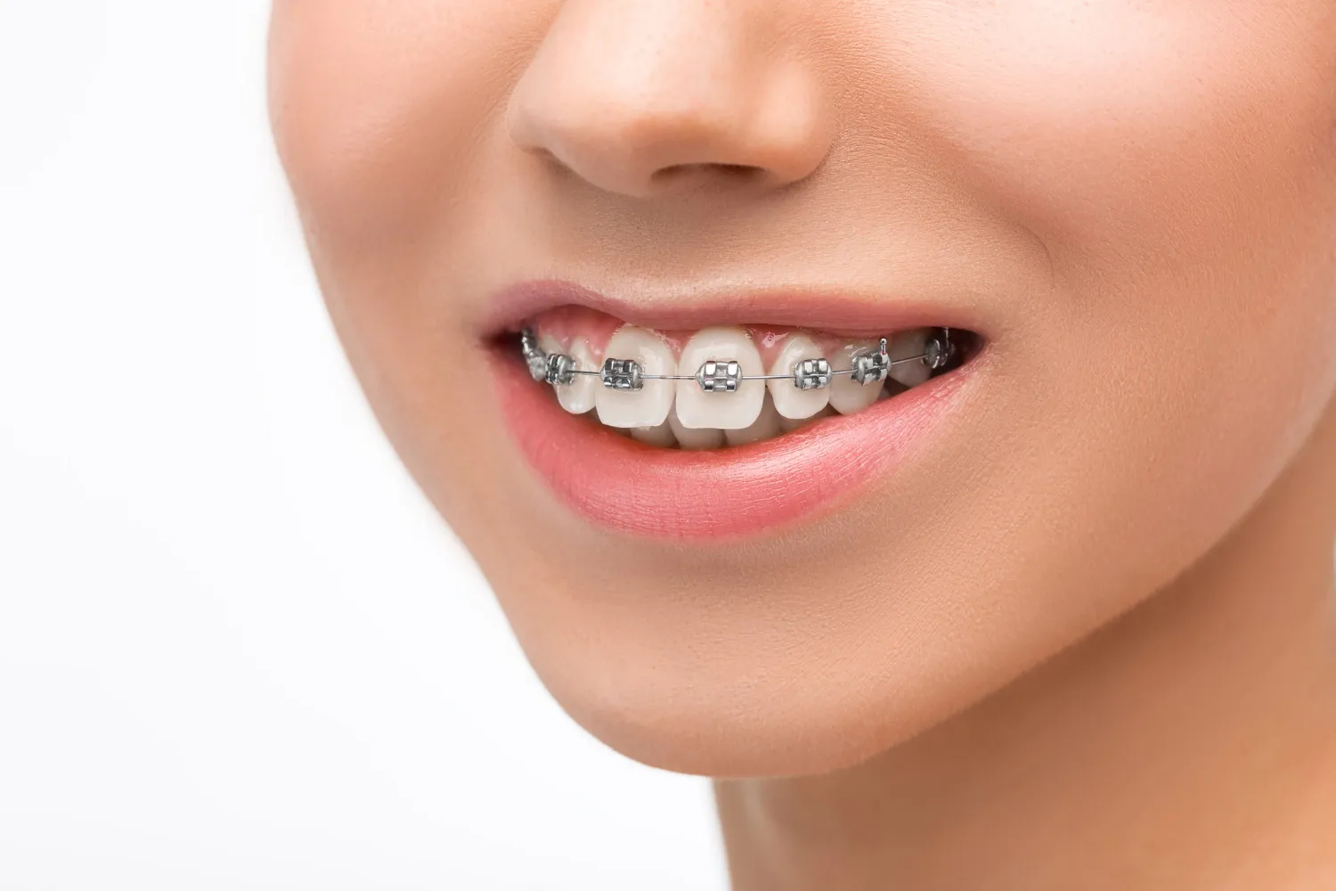 How Braces Los Angeles Can Support Straighter Teeth and Smile Goals