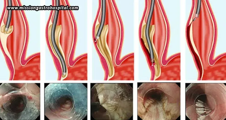 Mission Gastro Hospital: Specialized Gastroenterology Care For POEM