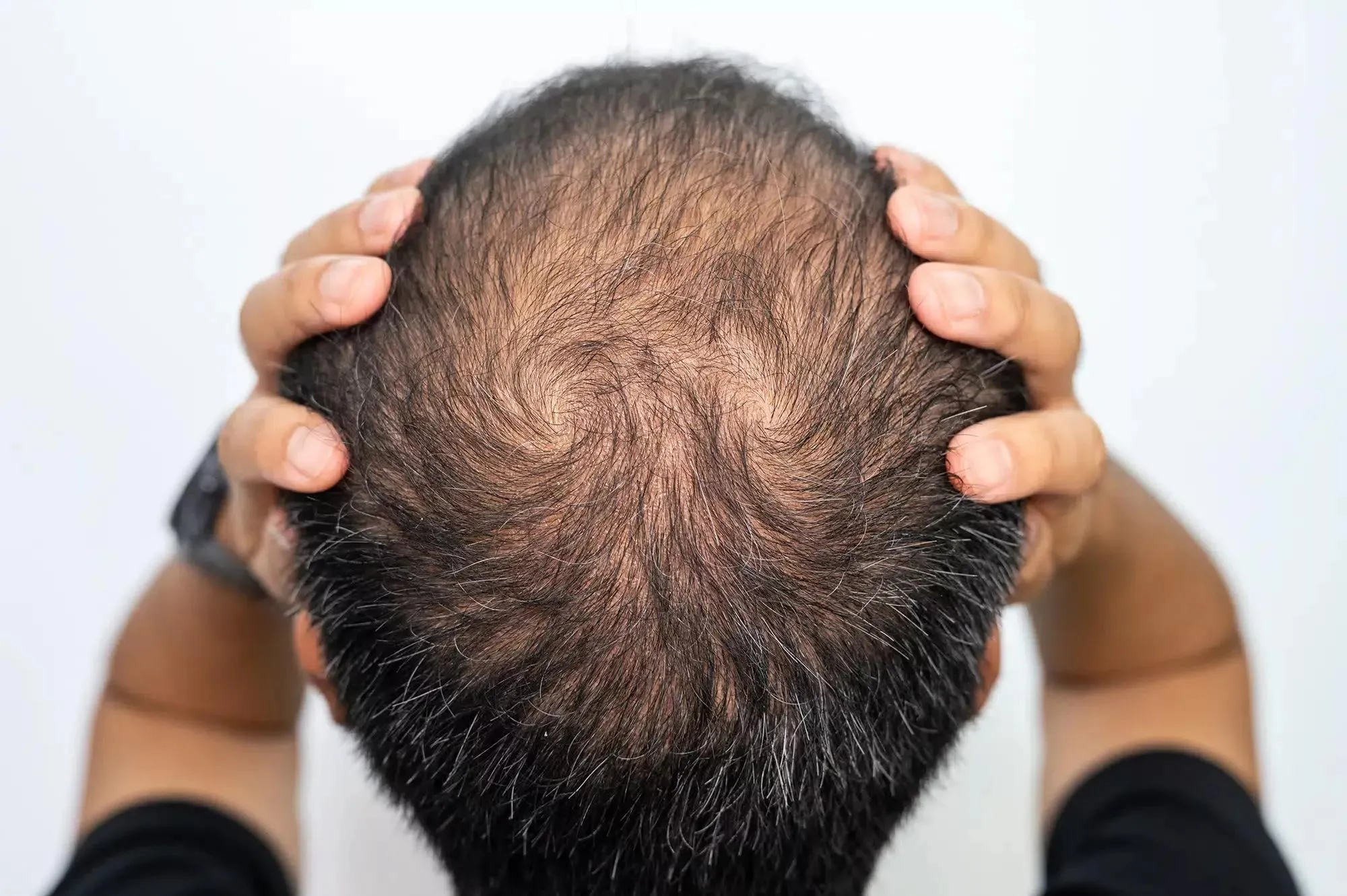 Hair Thinning in Mumbai: Causes, Treatments & Expert Care