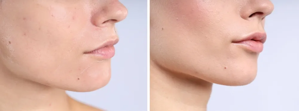 What Are the Long-Term Benefits of a PRX Peel Treatment?