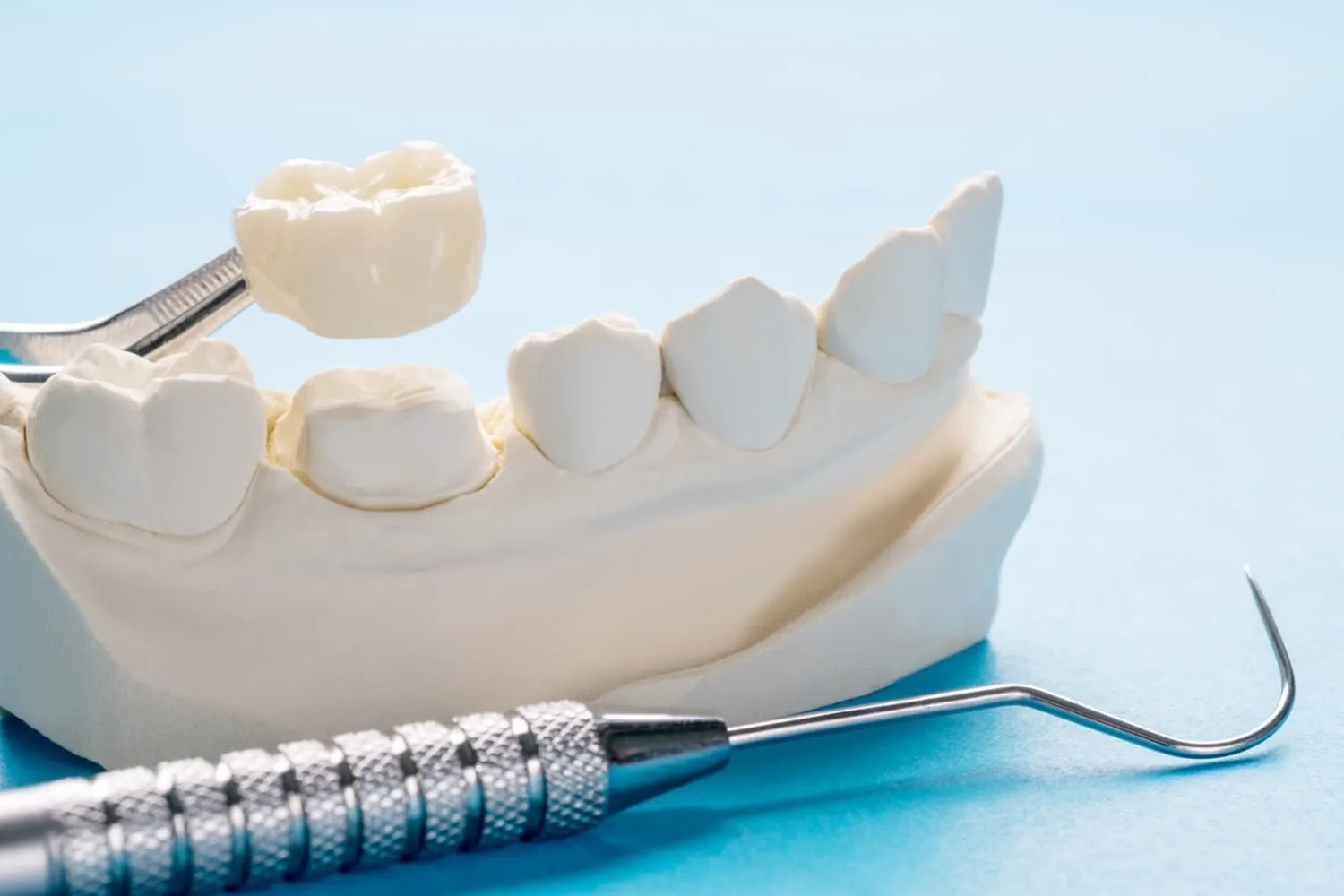 What to Know About Partial Crowns in Tustin for Restoring Damaged Teeth