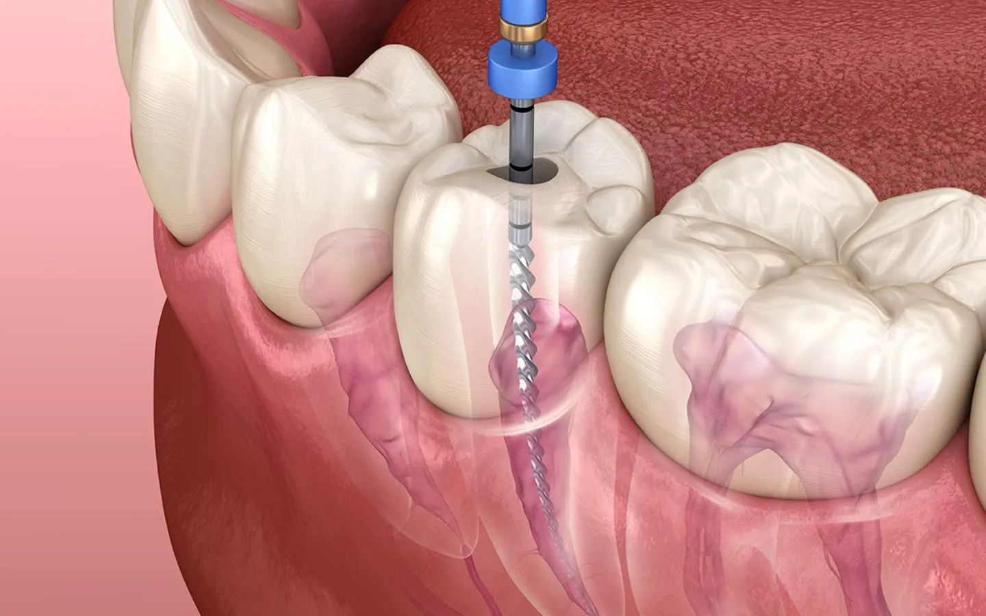 Root Canal Treatment: When Do You Need It and What Should You Expect?