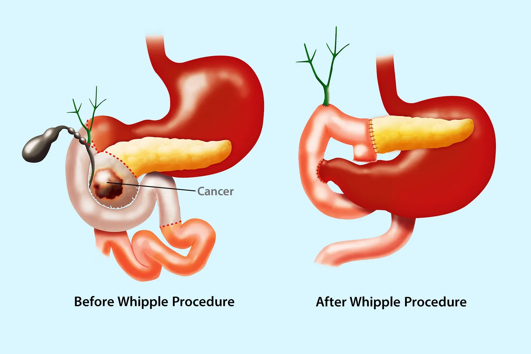 Pancreatic Cancer and the Whipple Procedure: Modern Surgical Approaches