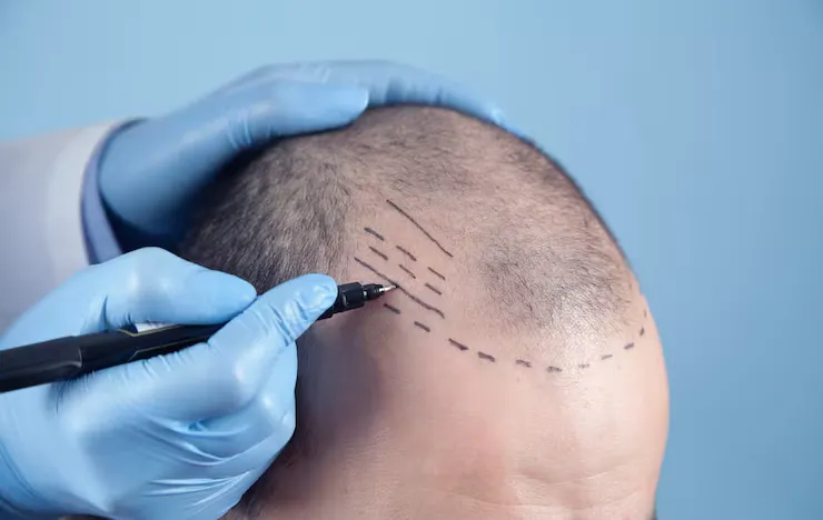What to Know Before Choosing a DHI Hair Transplant London Treatment