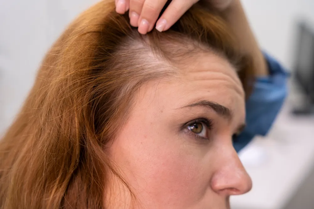 Understanding Hair Loss Alopecia London and Available Treatment Options