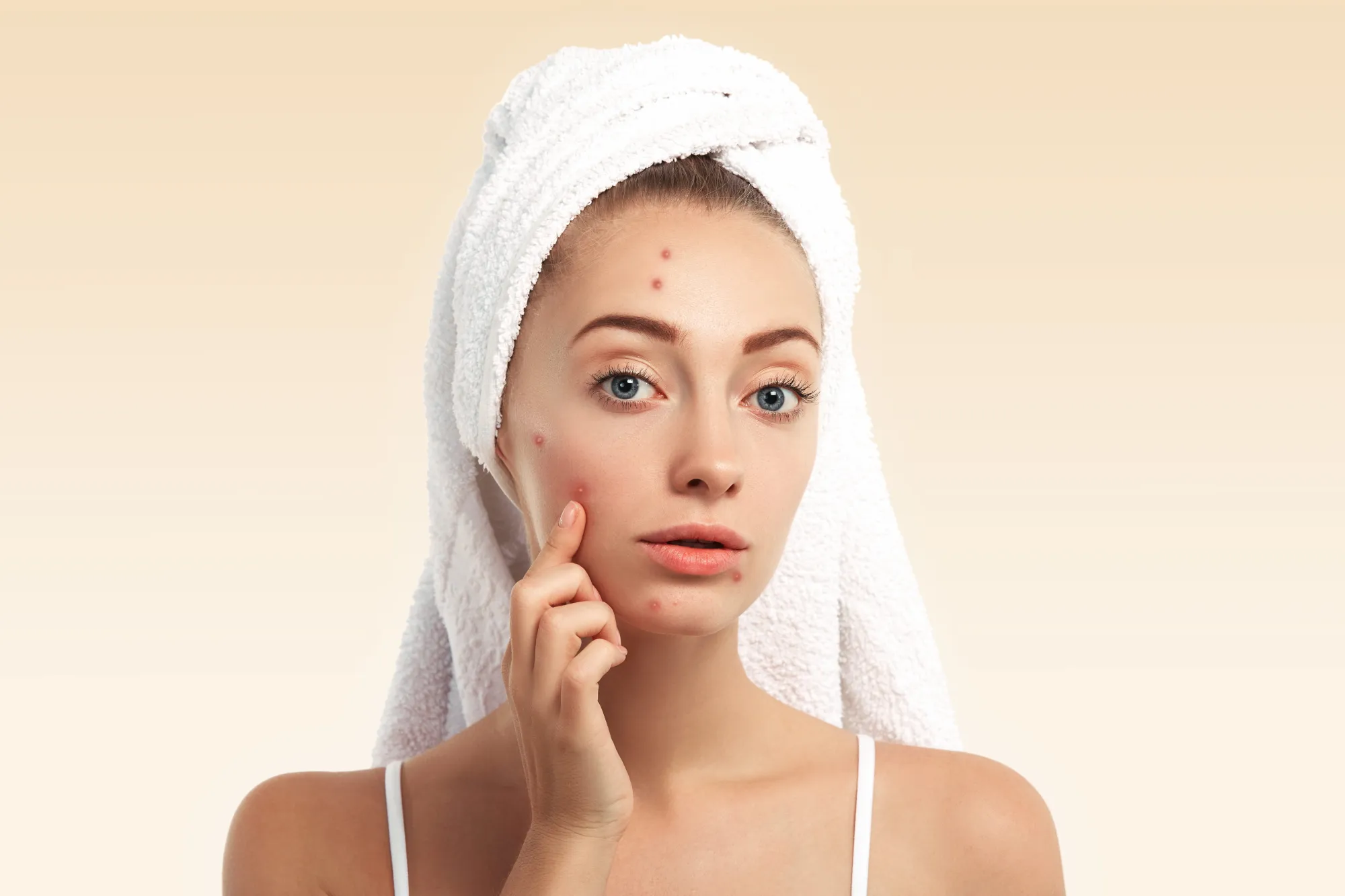 What Is Acne? Causes, Types, Symptoms & Treatment