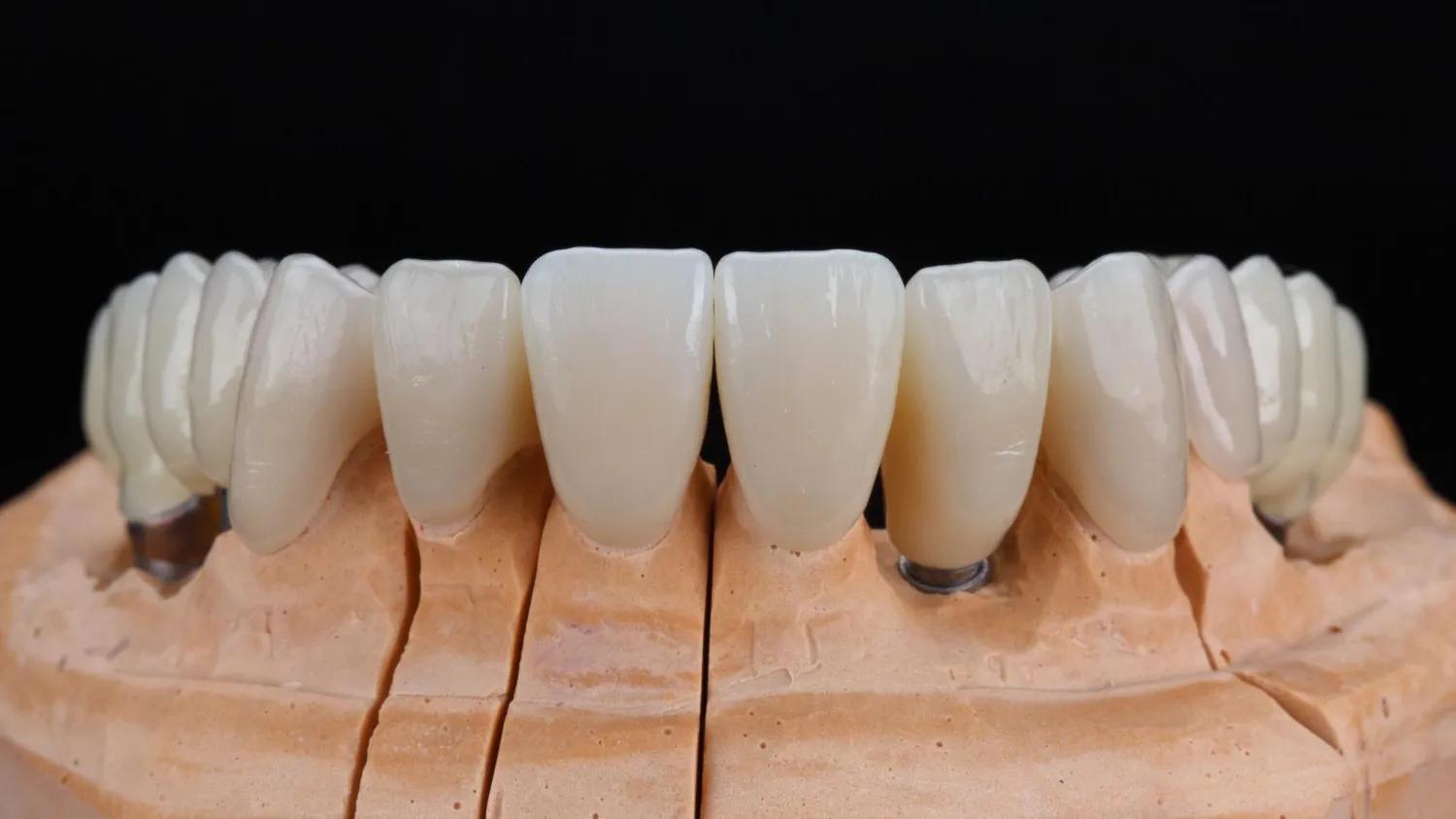 How Same Day Dental Crowns Scottsdale Can Simplify the Tooth Restoration Process