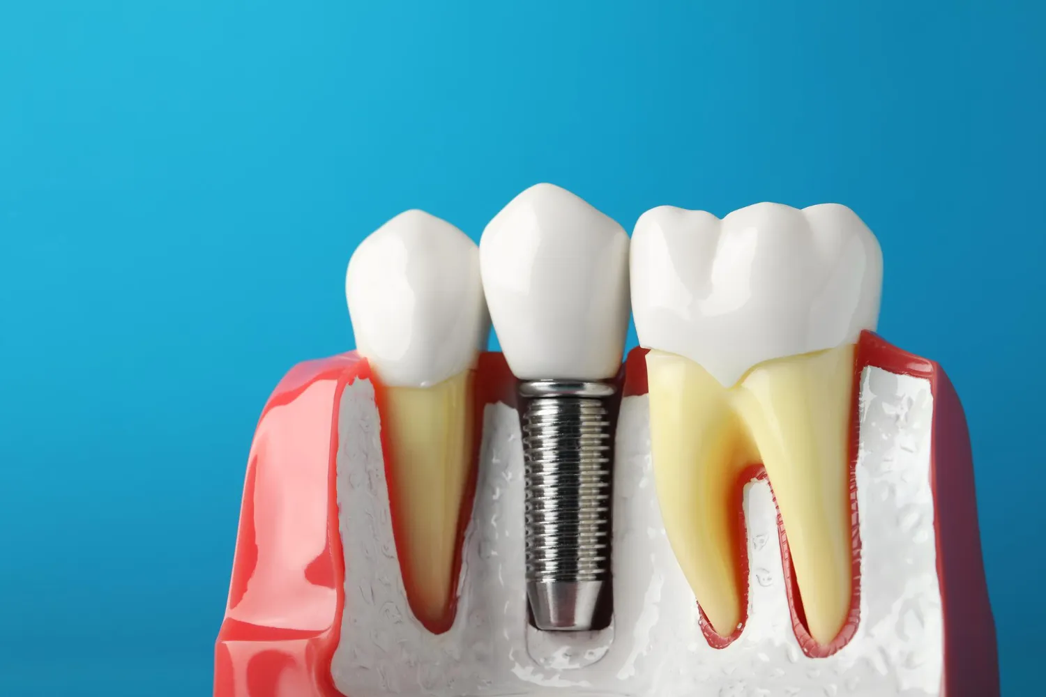 Replacing Missing Teeth and Restoring Function with a Tooth Implant Scottsdale