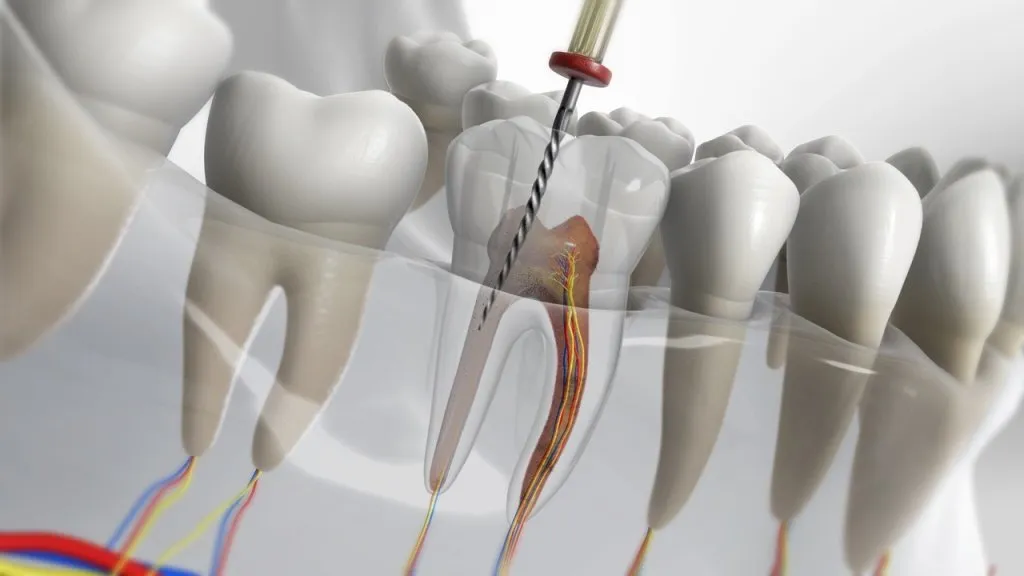 Root Canal Treatment in Bibwewadi: Why Ignoring Tooth Pain Can Cost More