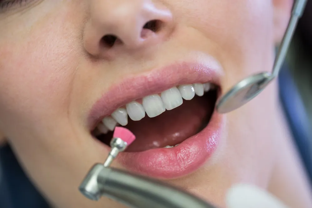 Brightening a Smile Safely with Professional teeth whitening Somerville