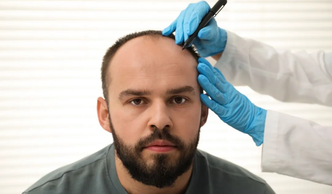 Can Hair Transplants Treat Different Stages of Baldness?