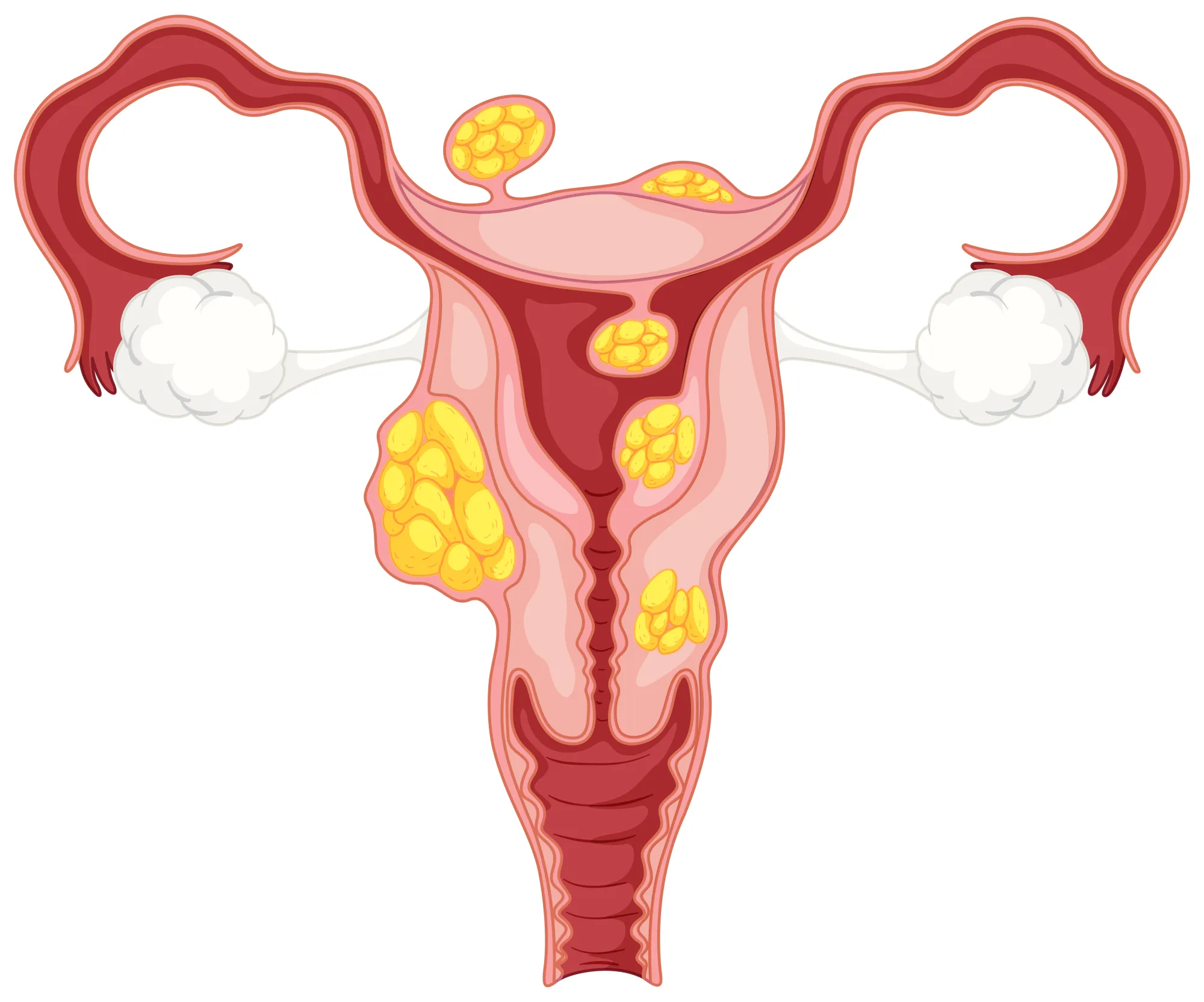 Fibroid Symptoms: How to Recognize Changes in Your Menstrual and Pelvic Health