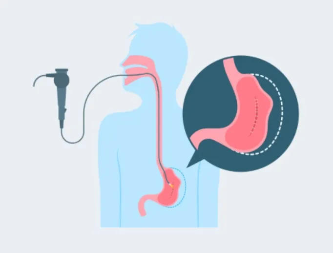 Bariatric Surgery in Ghaziabad: A Surgical Approach to Weight Management