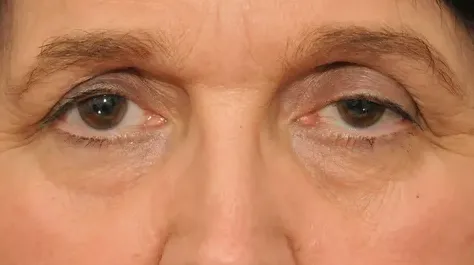 Can Lower Blepharoplasty Treat Puffy Lower Eyelids?