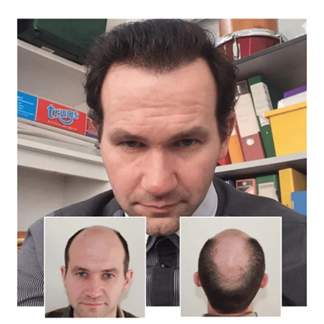 Choosing a Hair Loss Clinic: 10 Factors Worth Considering