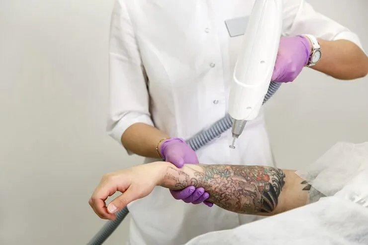 Tattoo Removal Nottingham Guide to Fading Unwanted Ink Over Time Safely