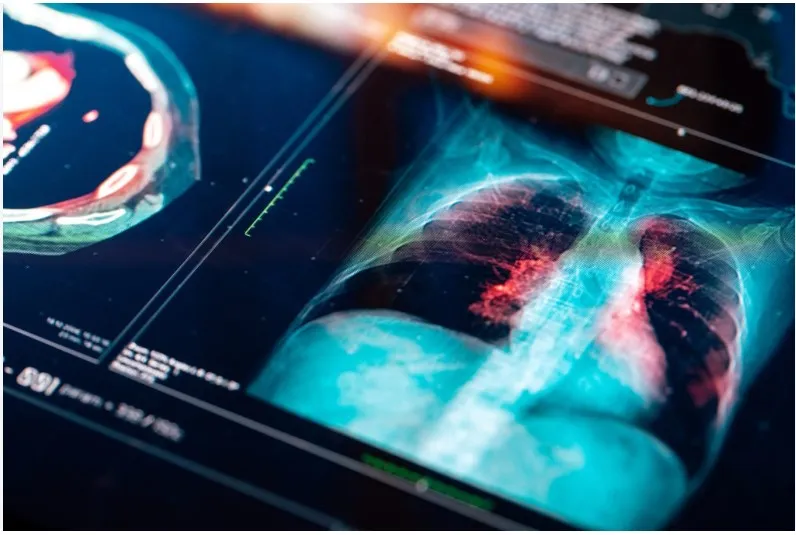 Lung Cancer in Hong Kong: Understanding Risks, Health Management, and Support Resources