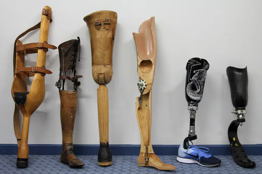 Types of Prosthetic Leg: Which One May Suit Your Needs?