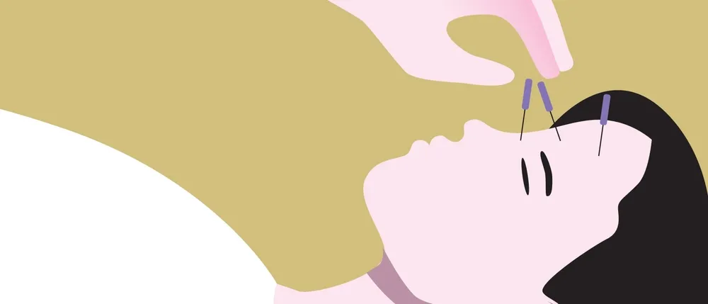 What Is Acupuncture for Mental Health and How Can It Help?