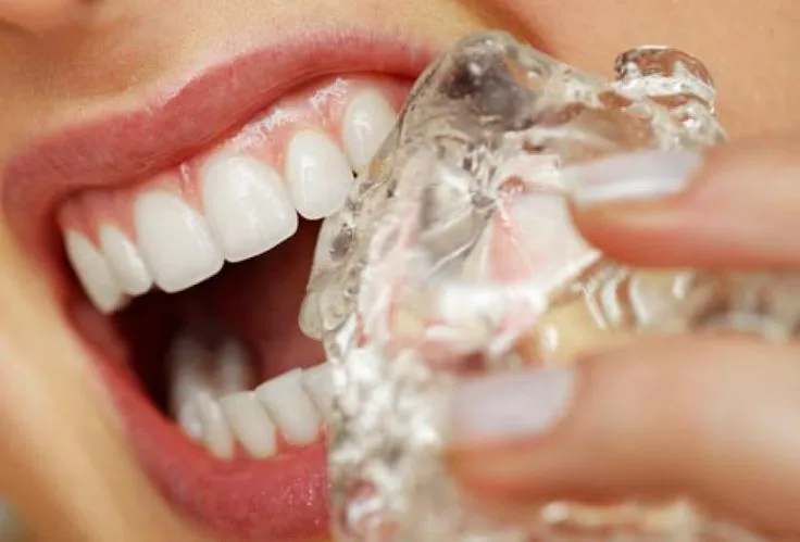 What to Know Before Choosing Invisalign in Dubai
