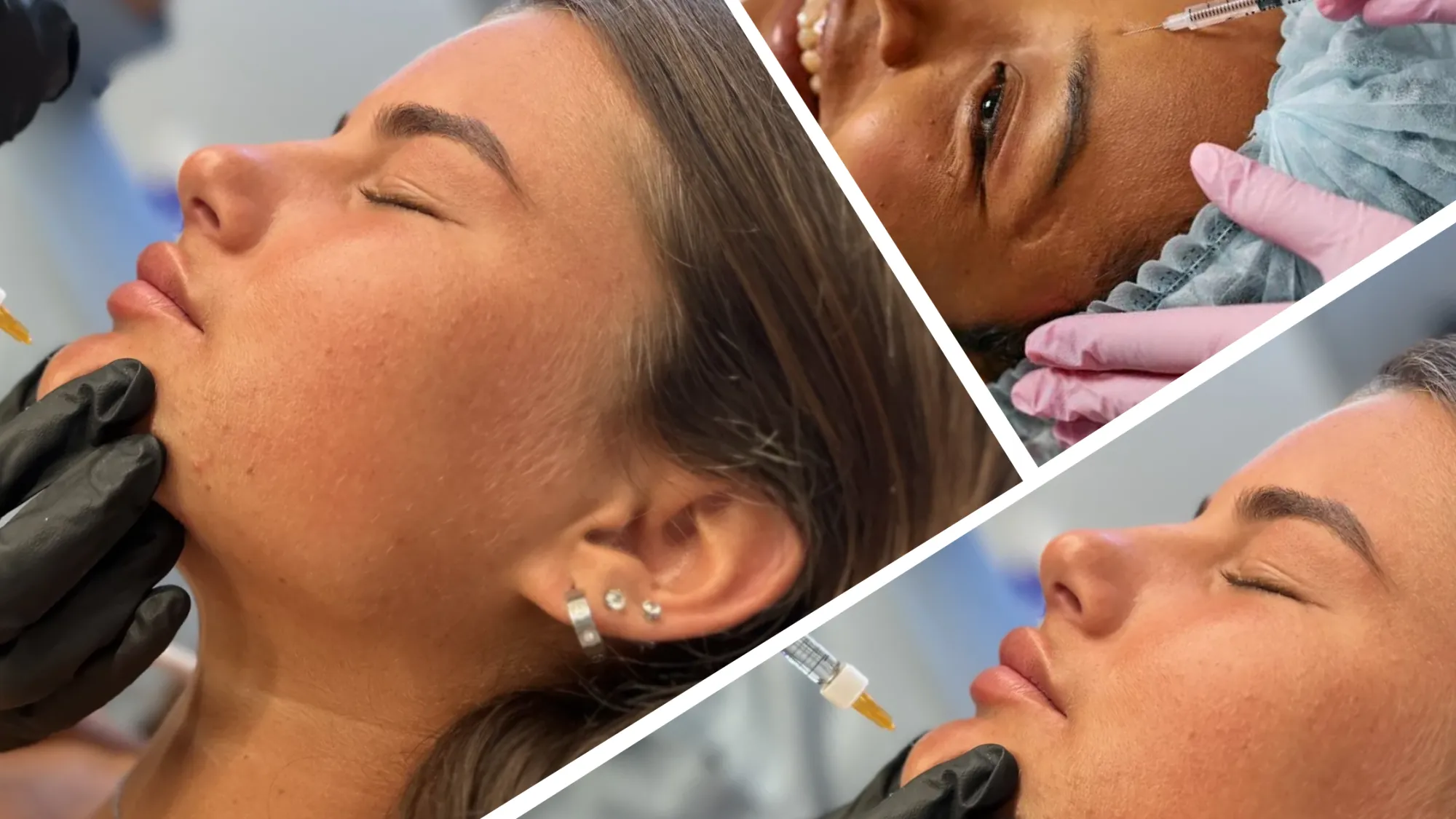 Dermal Fillers vs Botox: What's the Difference?