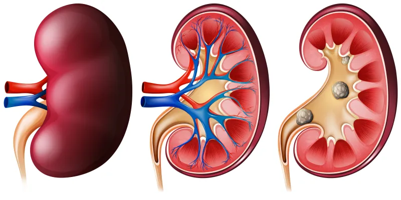 How Much Water Should You Drink to Help Prevent Kidney Stones?