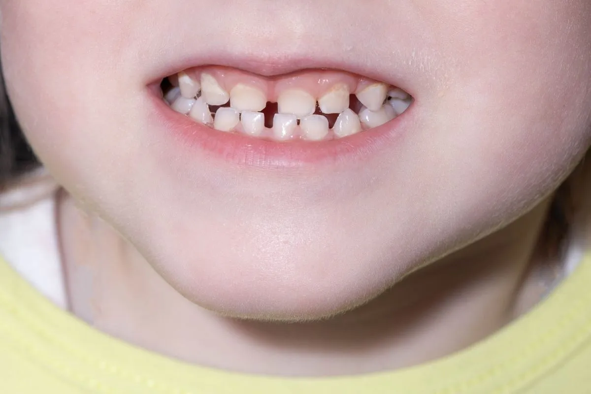 Why Baby Teeth Need Protection Even Though They Eventually Fall Out