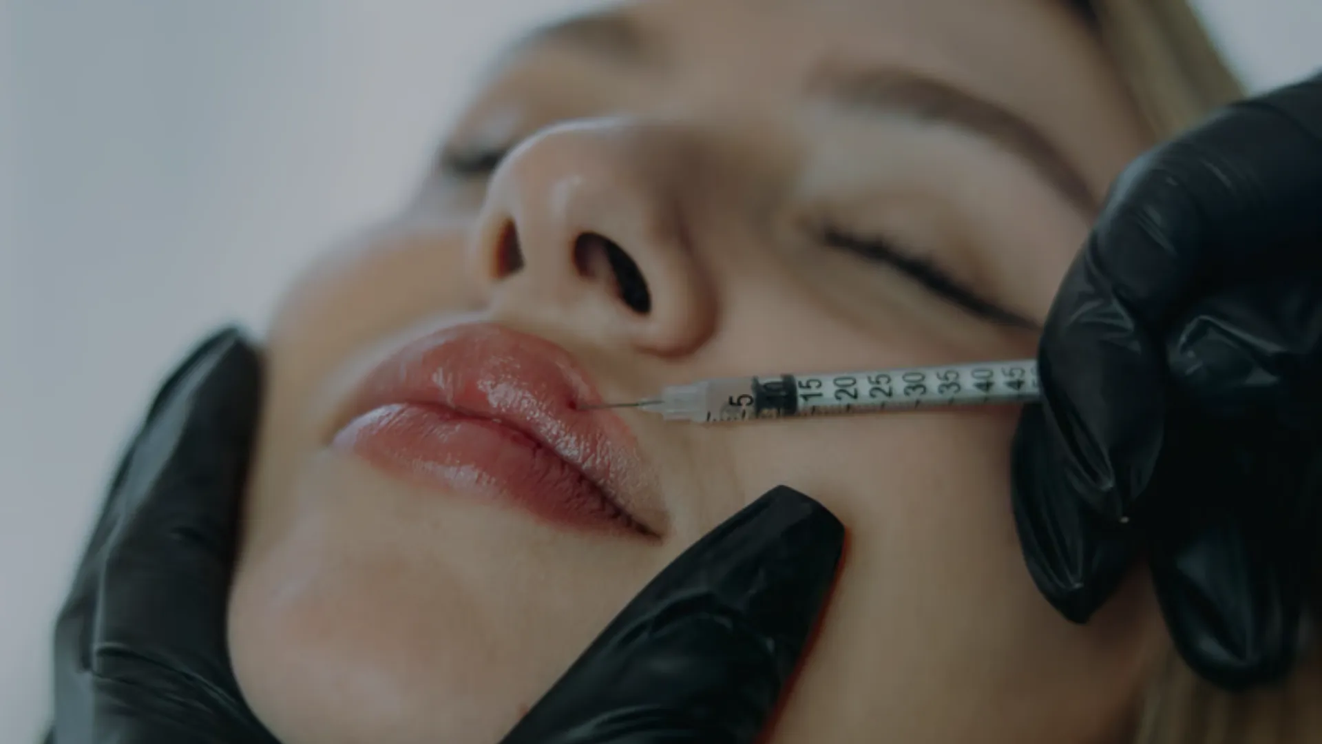 Lip Filler Vaughan: A Complete Guide to Natural-Looking Lip Enhancement