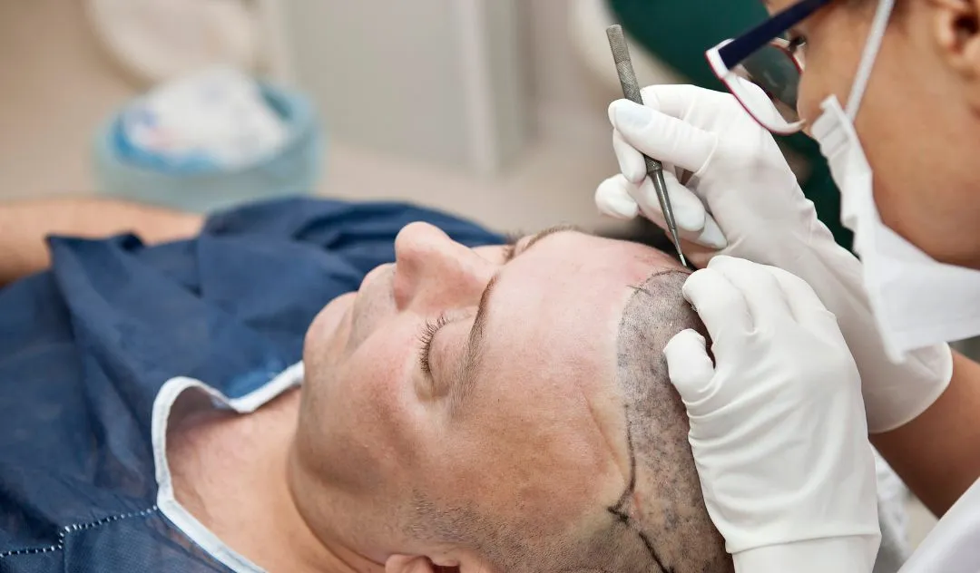 Why Choosing the Right Hair Transplant Clinic Matters