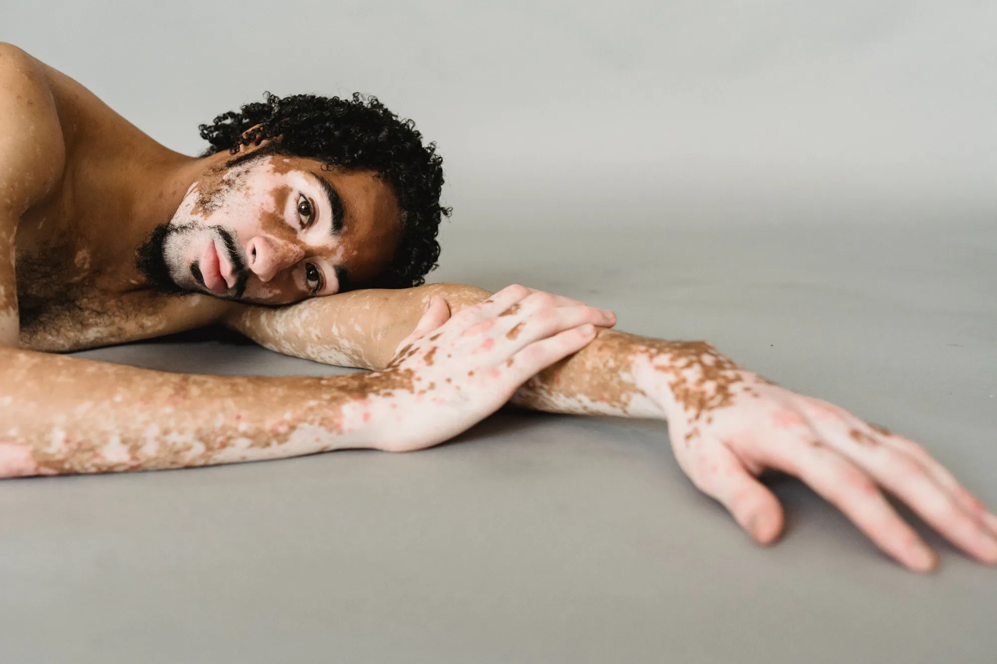 Psoriasis vs Eczema: How to Tell the Difference and When Should You See a Doctor?
