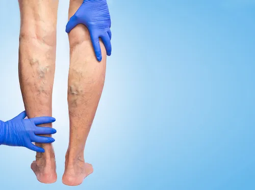 Varicose Veins: Vascular Surgeon Treatment Options