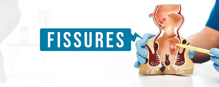When to Seek Immediate Fissure Treatment in Narnaul