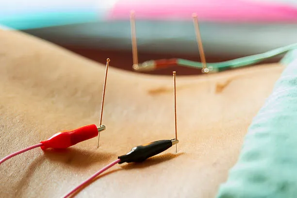 Understanding Electro-Acupuncture: How This Therapy Works