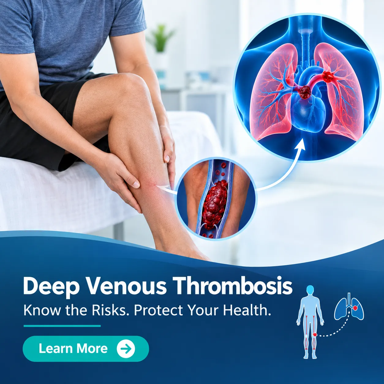 Deep Venous Thrombosis and Pulmonary Embolism: How Are They Connected?