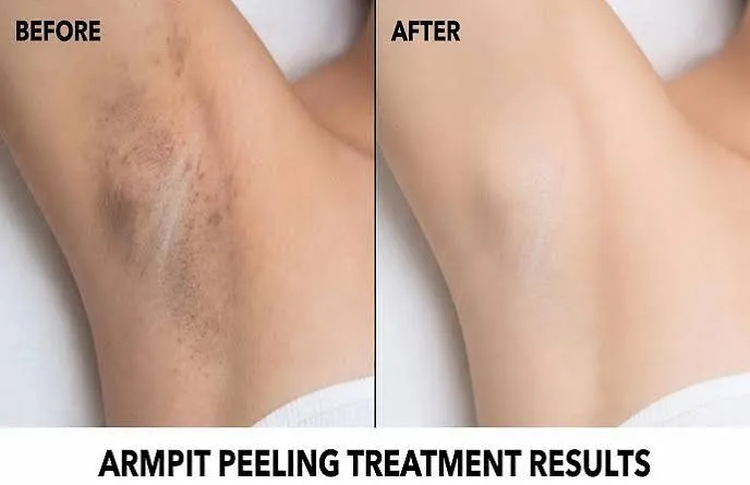 Underarm Chemical Peel: What to Know Before Treatment