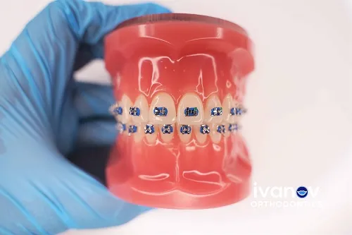 What Can You Expect During Invisalign Treatment in Miami?