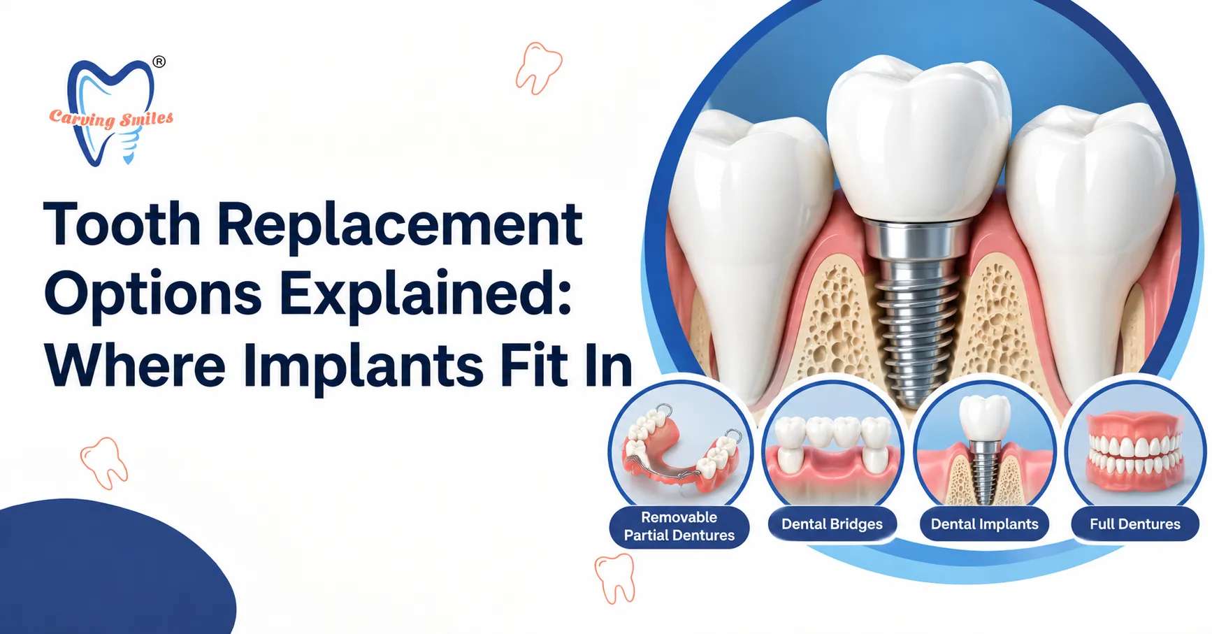Tooth Replacement Options Explained: Where Implants Fit In