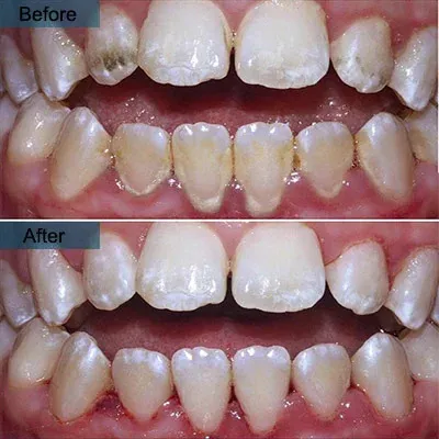 Why Tartar Is Different from Plaque—and Why That Difference Matters