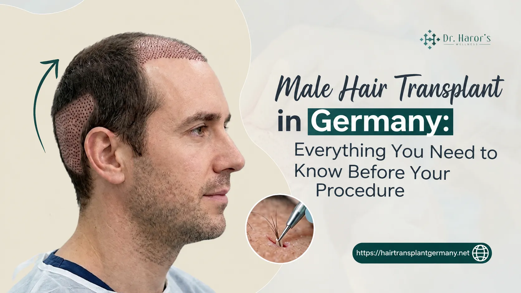 Male Hair Transplant in Germany: Everything You Need to Know Before Your Procedure