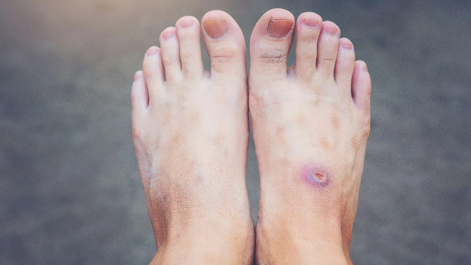 How to Recognize Poor Circulation in the Legs