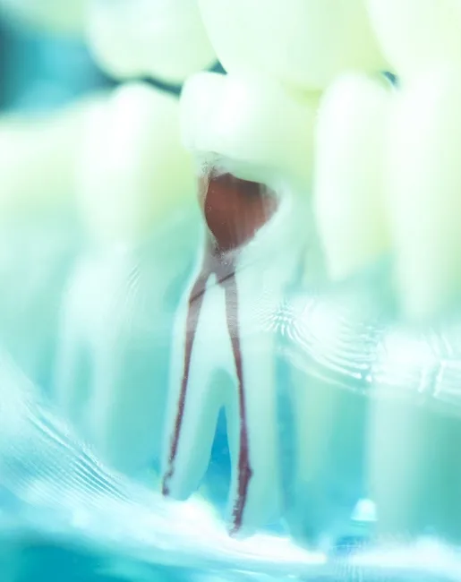 How Root Canal Treatment Helps Save an Infected Tooth