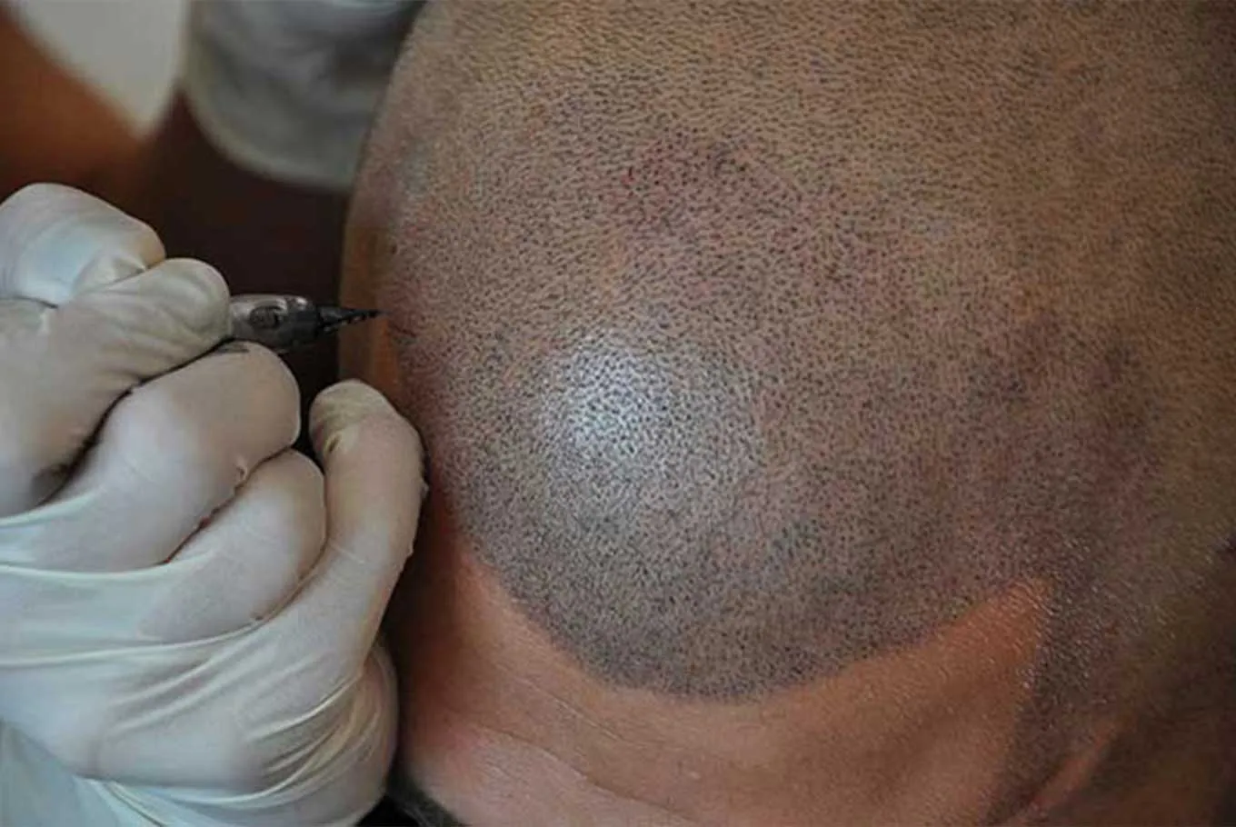 Hair Transplant in Ahmedabad: Complete Guide to Procedure, Benefits and Recovery