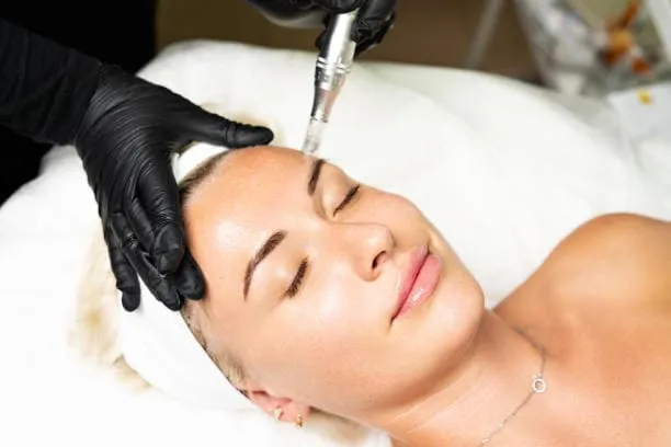 Smoother Skin and Reduced Scarring with Microneedling Glasgow